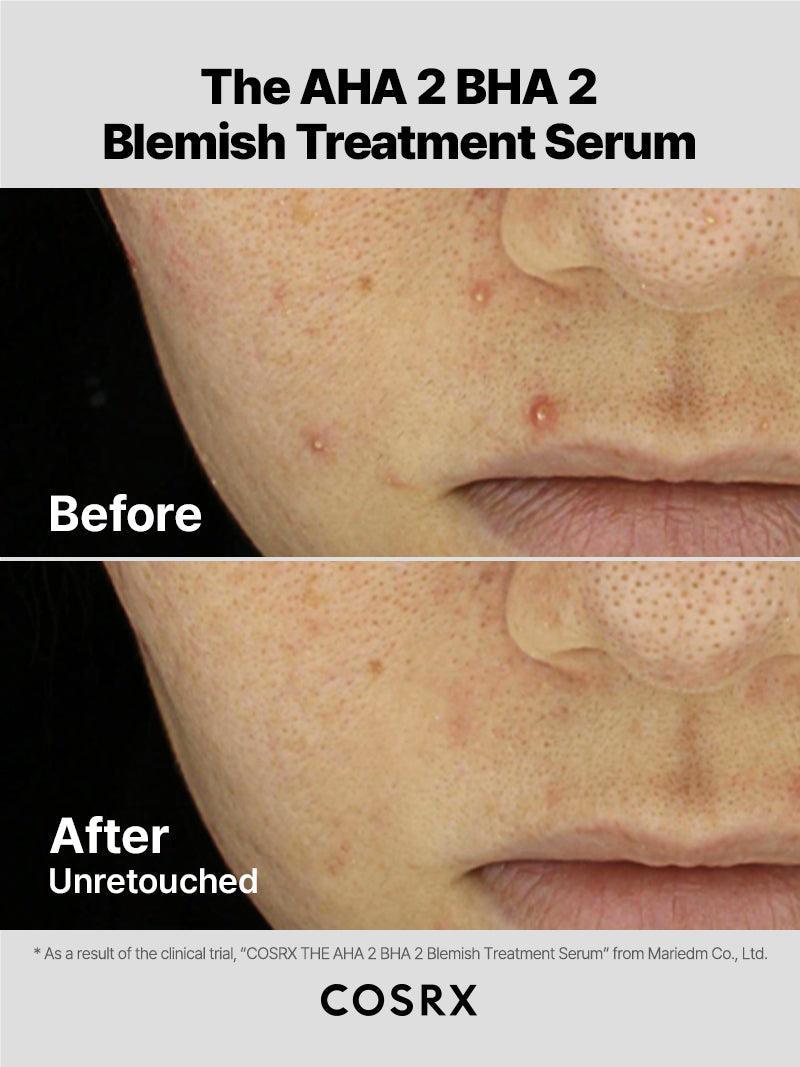 The AHA 2 BHA 2 Blemish Treatment Serum – COSRX Official